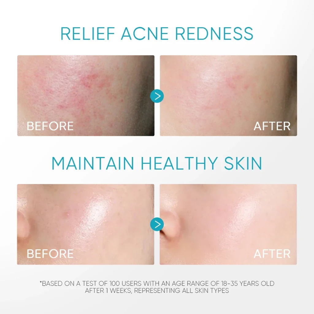 5% Panthenol Acne Calming Water Gel - Image 4